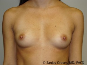 Mini Breast Augmentation Before and After 02 | Sanjay Grover MD FACS