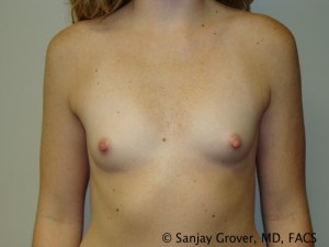 Mini Breast Augmentation Before and After | Grover Aesthetics