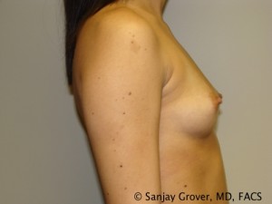 Mini Breast Augmentation Before and After 10 | Sanjay Grover MD FACS