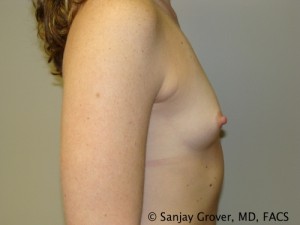 Mini Breast Augmentation Before and After 10 | Sanjay Grover MD FACS