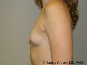 Mini Breast Augmentation Before and After 10 | Grover Aesthetics