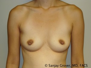 Mini Breast Augmentation Before and After 05 | Sanjay Grover MD FACS