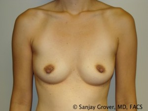 Mini Breast Augmentation Before and After 09 | Sanjay Grover MD FACS