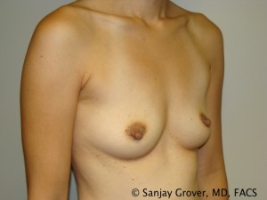 Mini Breast Augmentation Before and After 11 | Grover Aesthetics