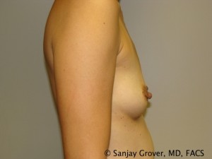 Mini Breast Augmentation Before and After 11 | Grover Aesthetics