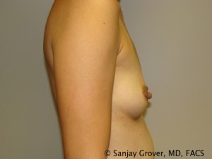 Mini Breast Augmentation Before and After 11 | Sanjay Grover MD FACS