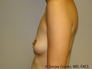 Mini Breast Augmentation Before and After 11 | Sanjay Grover MD FACS