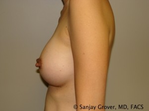 Mini Breast Augmentation Before and After 11 | Grover Aesthetics