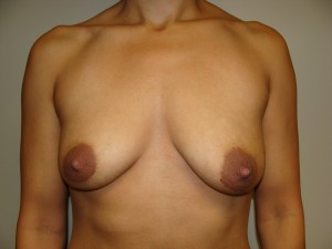 Mini Breast Lift Before and After 09 | Sanjay Grover MD FACS