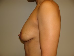 Mini Breast Lift Before and After 05 | Grover Aesthetics