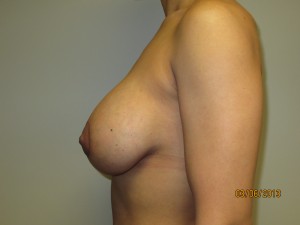 Mini Breast Lift Before and After 05 | Grover Aesthetics