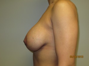 Mini Breast Lift Before and After 05 | Sanjay Grover MD FACS