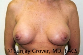 Mini Breast Lift Before and After | Sanjay Grover MD FACS