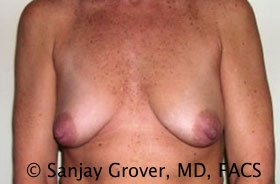 Mini Breast Lift Before and After | Grover Aesthetics