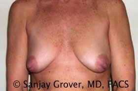 Mini Breast Lift Before and After 05 | Sanjay Grover MD FACS