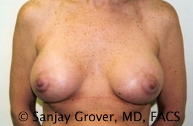 Mini Breast Lift Before and After | Grover Aesthetics