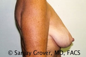 Mini Breast Lift Before and After 09 | Grover Aesthetics