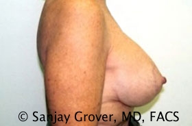 Mini Breast Lift Before and After 09 | Grover Aesthetics