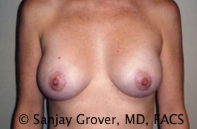 Mini Breast Lift Before and After | Grover Aesthetics