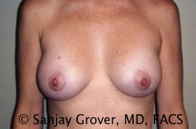 Mini Breast Lift Before and After 10 | Sanjay Grover MD FACS