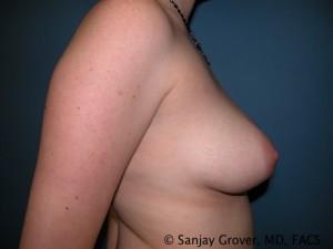 Mini Breast Lift Before and After 15 | Grover Aesthetics