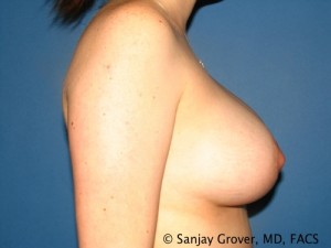 Mini Breast Lift Before and After 15 | Grover Aesthetics