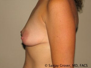 Mini Breast Lift Before and After 15 | Sanjay Grover MD FACS