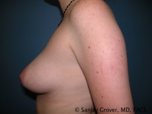 Mini Breast Lift Before and After 15 | Grover Aesthetics