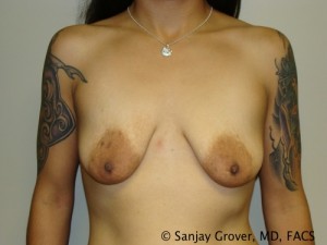 Mini Breast Lift Before and After 03 | Sanjay Grover MD FACS