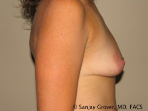 Mini Breast Lift Before and After 16 | Grover Aesthetics
