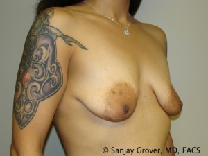 Mini Breast Lift Before and After 17 | Grover Aesthetics