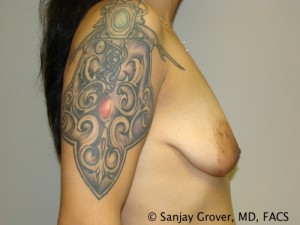 Mini Breast Lift Before and After 17 | Grover Aesthetics