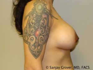 Mini Breast Lift Before and After 17 | Grover Aesthetics