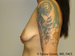 Mini Breast Lift Before and After 17 | Grover Aesthetics