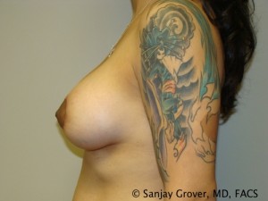 Mini Breast Lift Before and After 17 | Grover Aesthetics