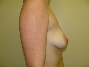 Mini Breast Lift Before and After 19 | Grover Aesthetics