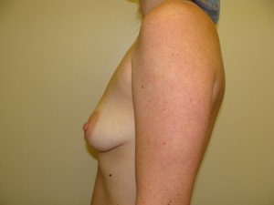 Mini Breast Lift Before and After 19 | Grover Aesthetics