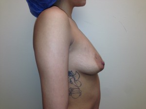 Mini Breast Lift Before and After 20 | Grover Aesthetics