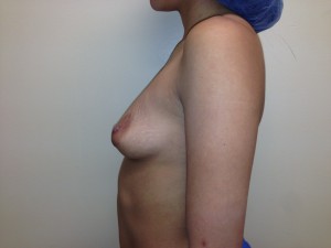 Mini Breast Lift Before and After 20 | Sanjay Grover MD FACS