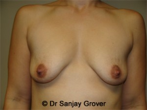 Mini Breast Lift Before and After 01 | Sanjay Grover MD FACS