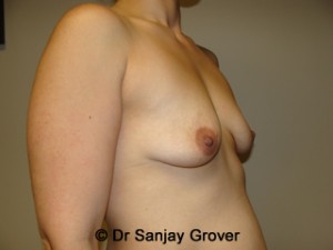 Mini Breast Lift Before and After 21 | Grover Aesthetics