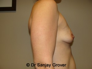 Mini Breast Lift Before and After 21 | Grover Aesthetics