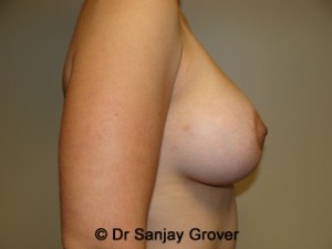 Mini Breast Lift Before and After 21 | Grover Aesthetics