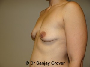 Mini Breast Lift Before and After 21 | Grover Aesthetics