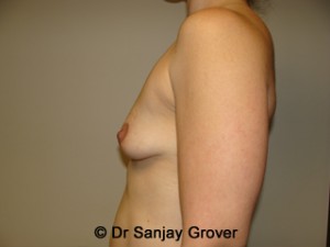 Mini Breast Lift Before and After 21 | Grover Aesthetics