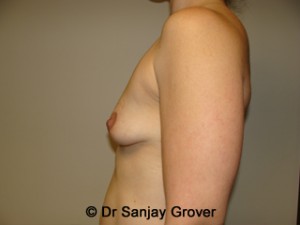 Mini Breast Lift Before and After 21 | Sanjay Grover MD FACS