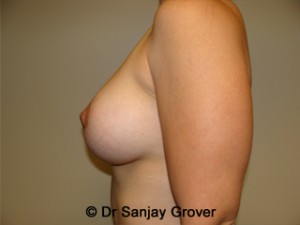 Mini Breast Lift Before and After 21 | Grover Aesthetics