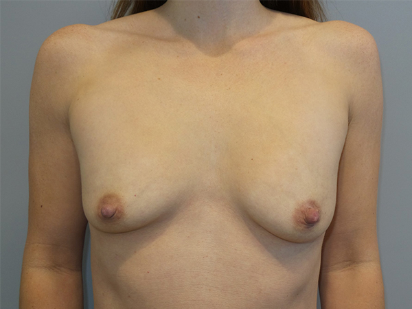 Mini Breast Lift Before and After 10 | Sanjay Grover MD FACS