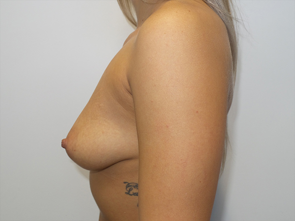 Mini Breast Lift Before and After 26 | Grover Aesthetics