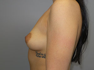 Mini Breast Lift Before and After 27 | Grover Aesthetics